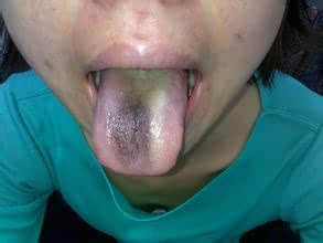 舌苔发黑是怎么回事