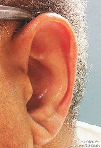 耳垂皱褶预示可能患冠心病了!