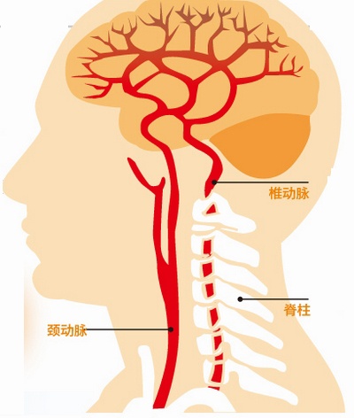 走路不稳切忌大脑后循环缺血