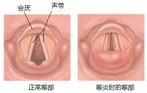 不可小视的儿科急症——急性喉炎