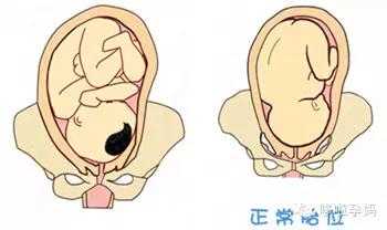 由于胎位异常将给分娩带来程度不同的困难和危险,故早期纠正胎位,对