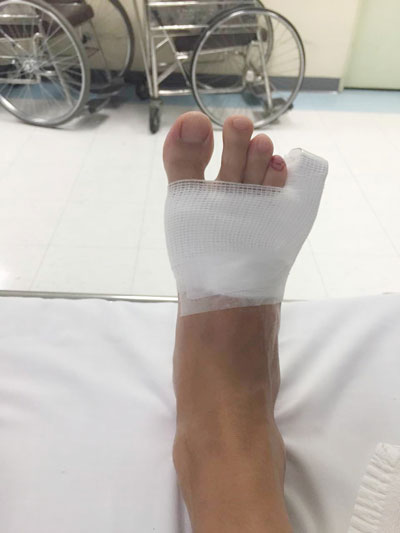 关智斌在泰国取景一场戏中发生意外,踢到泳池壁导致脚尾趾大量出血