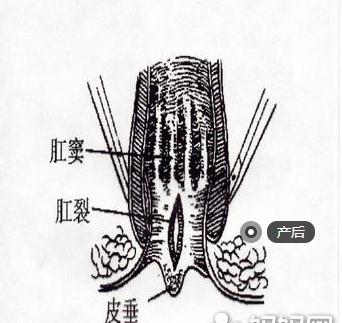 在分娩后的女性中是很多见的,而且能够导致产后肛裂的原因也是较多的