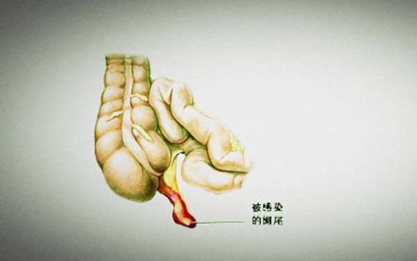 腹腔镜阑尾切除有什么优势