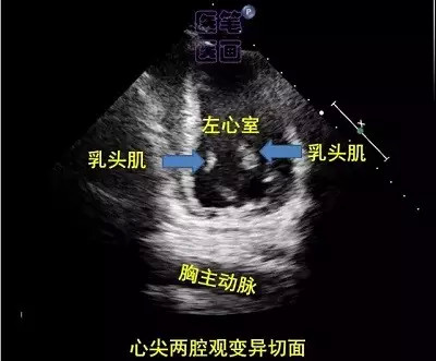 【实用】最萌心脏超声入门图谱