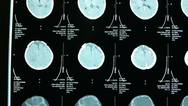 2014-9-1:头颅ct:蛛网膜下腔出血,双额硬膜下急性血肿(少量).