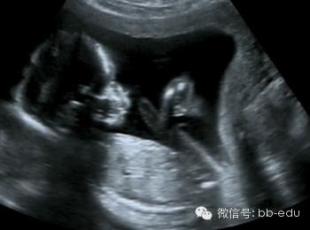 畸形胎儿被流产前,妈妈看到子宫内这一幕后保胎