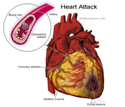 心脏最怕什么?