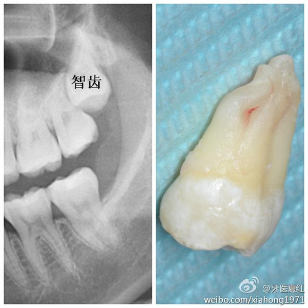 上颌低位埋伏智齿的拔除