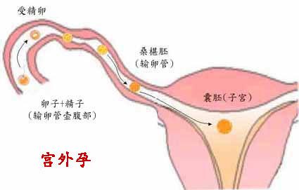 刚发现宫外孕怎么办