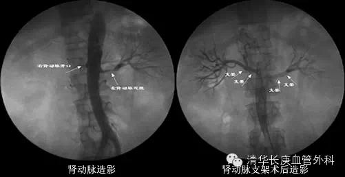 肾动脉狭窄—— 肾功能损害的隐匿杀手