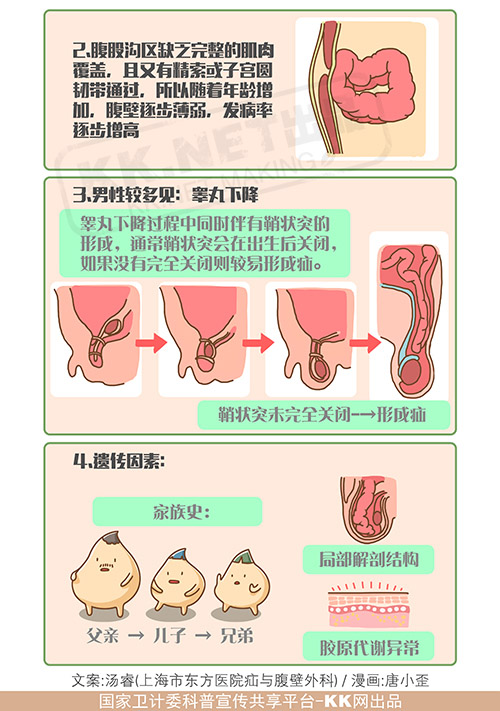 当人类开始直立行走——腹股沟疝来了