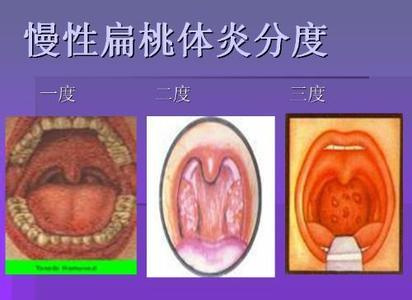 贵阳市口腔医院 专家解析:慢性扁桃体炎的3大典型症状 一,全身症状