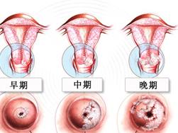宫颈癌,有时也可采用化学药物治疗