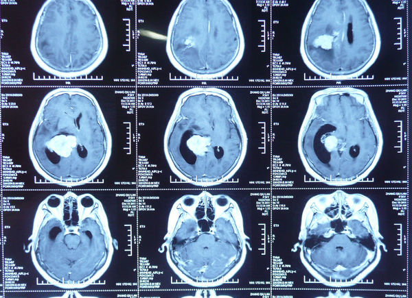 诊断:右侧脑室.手术完整切除.病理证实:右侧脑室脑膜瘤.