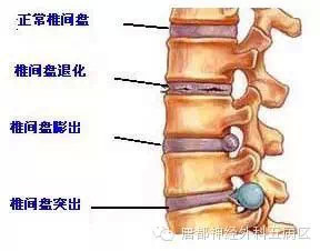 腰椎间盘突出和膨出有什么区别