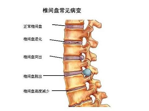 名医与您谈疾病:腰椎间盘突出怎么破?