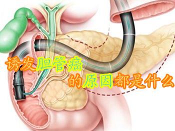 诱发胆管癌的原因都是什么