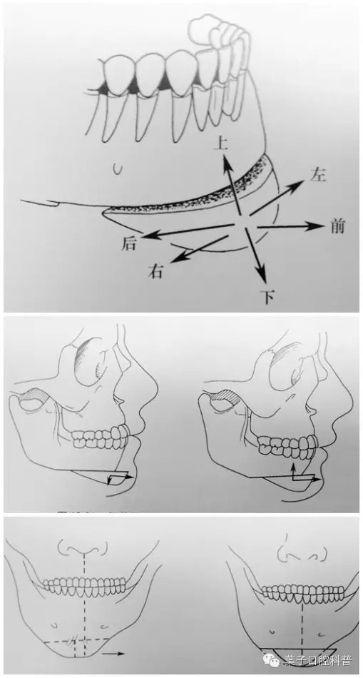 包括矫正颏部发育过度,发育不良以及颏部偏斜等涉及颏部前后,上下及