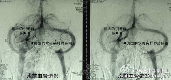 给静脉血管湖泊泄流补漏口