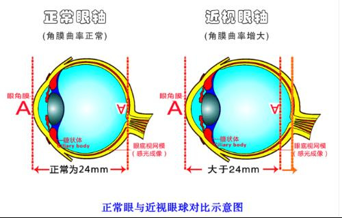 孩子近视后你这么做是错的