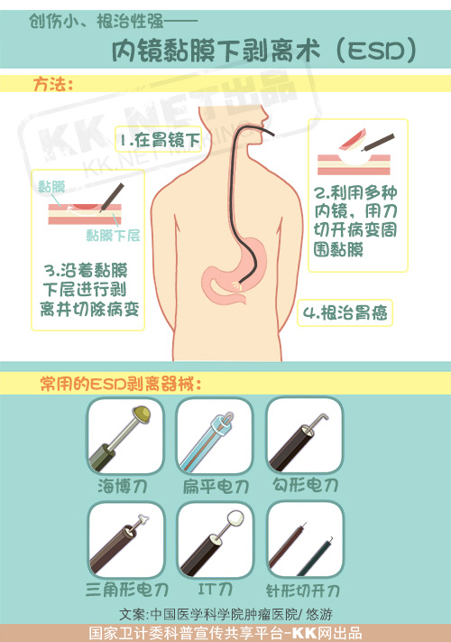 没有切口的胃癌手术—内镜黏膜下剥离术