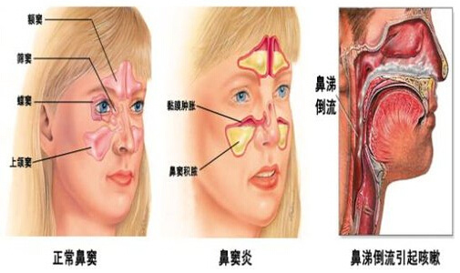 鼻炎要怎么预防?你怕不怕?