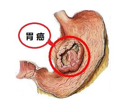 胃癌术后易导致哪些并发症