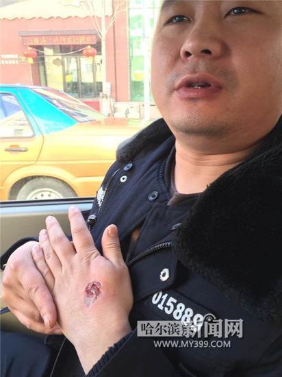民警手背的肉被咬掉。警方供片