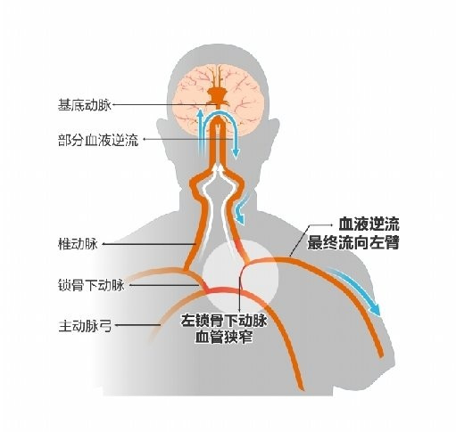 锁骨下动脉窃血综合征