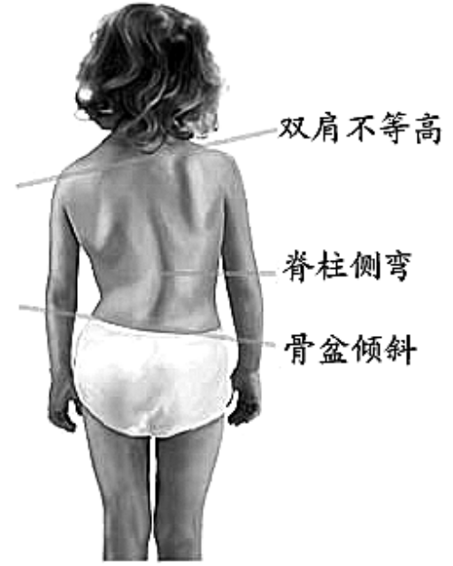 脱掉上衣一看,一侧肩胛骨明显突出,脊柱居然弯成了一个弧形.