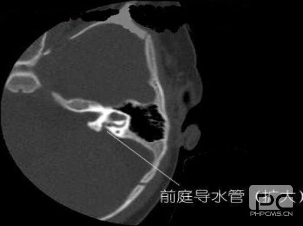 大前庭导水管对小孩有什么影响--上虞惠耳助听