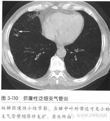 弥漫性泛细支气管炎ct征象