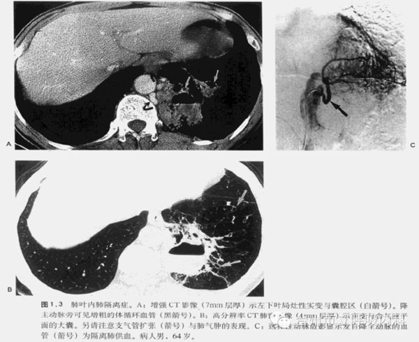 一组16例的资科显示,7例异常的肺实质内含有充液或不充液的囊腔(图1-2