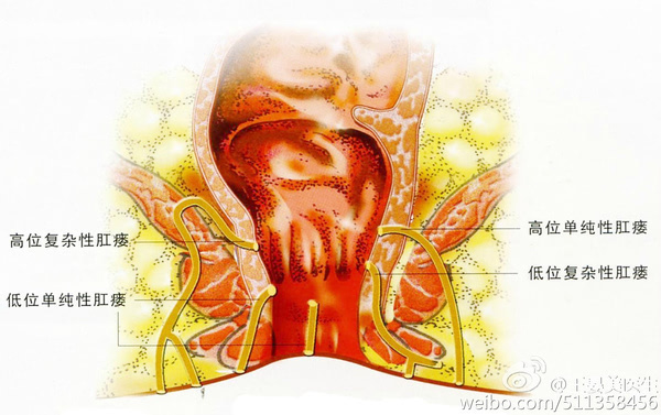 肛瘘八大复发原因解析