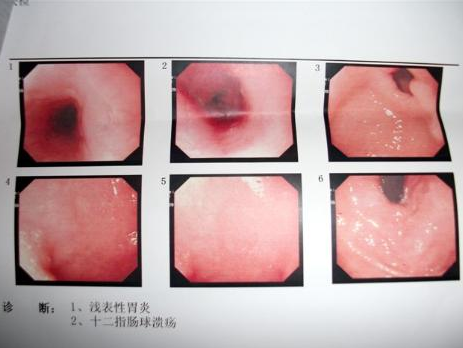 慢性浅表性胃炎的症状表现