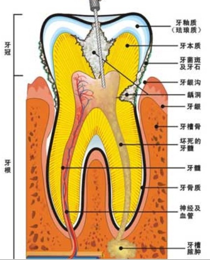 如何预防龋齿