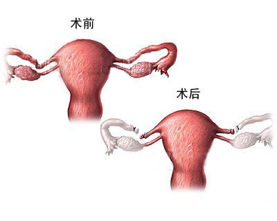 北科生殖专家视点:输卵管重度上举怎么治疗?