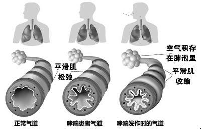 缅怀歌后邓丽君 哮喘病的预防与危害