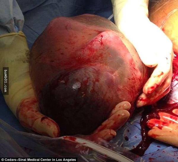 ▼图片所示为西拉斯的胎盘和脐带都蜷缩在羊膜囊中,他的小手和一条腿