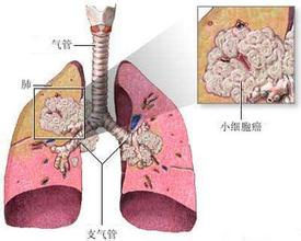 肺癌典型的五大症状