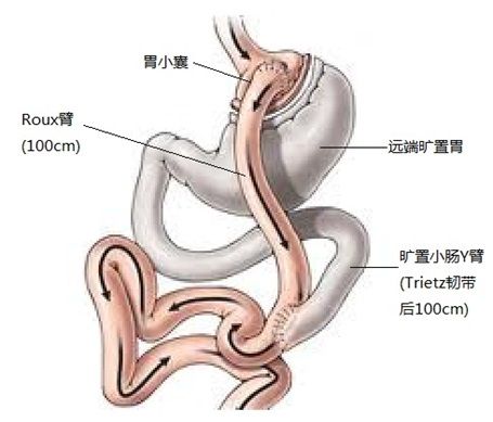 中国美容美体网 糖尿病 糖尿病手术治疗简介  (1)腹腔镜下roux-en-y胃