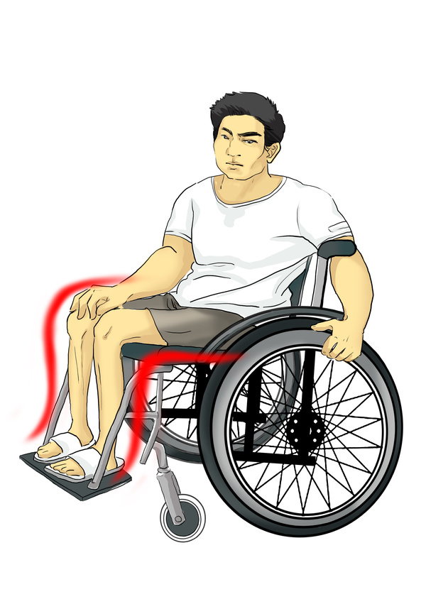 下肢截瘫后出现疼痛——病因源自于脊髓损伤