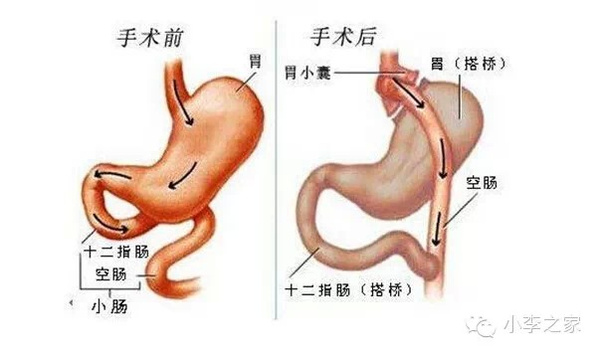 美国外科医师学会比较胃袖状切除术与胃旁路手术