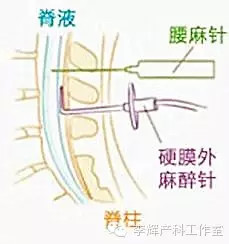 产科麻醉系列之剖宫产腰麻