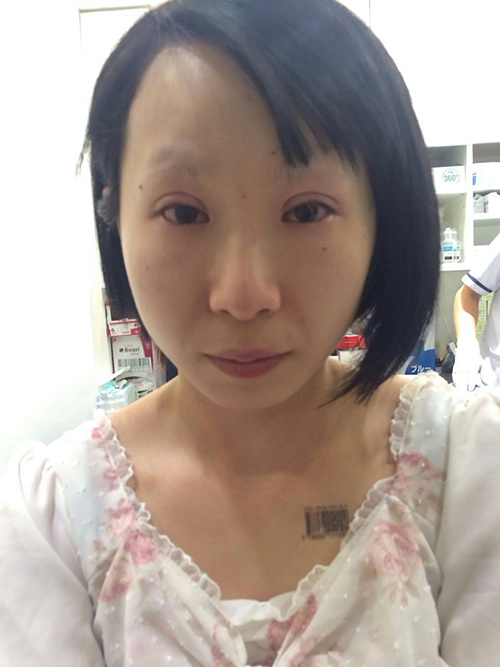 日本双眼皮手术过程-搜狐