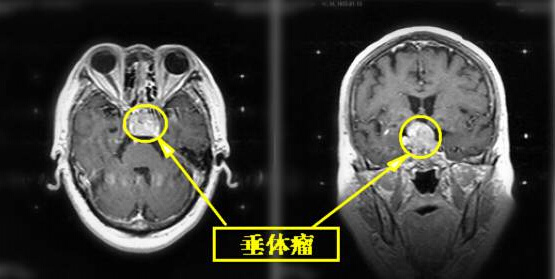 射波刀为垂体瘤患者盛开希望之花