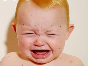 夏季宝宝感染水痘怎么办?