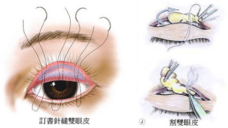 全面介绍双眼皮手术后的自然迷人双眼