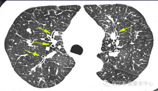 呈一种"印戒"的表现,这对支气管扩张有特征性